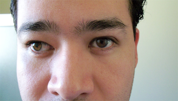Mắt lé gây hại như thế nào đến sức khỏe của bạn?
